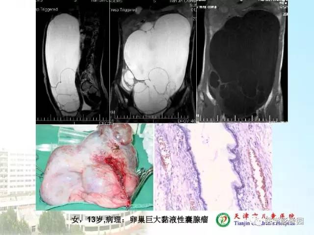 【PPT】小儿腹部肿瘤影像与病理对照