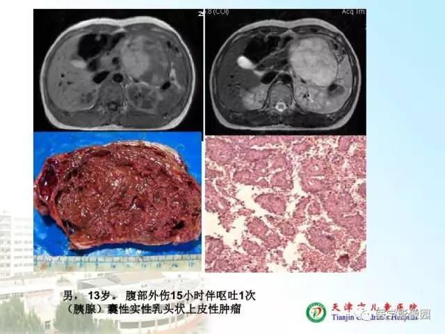 【PPT】小儿腹部肿瘤影像与病理对照