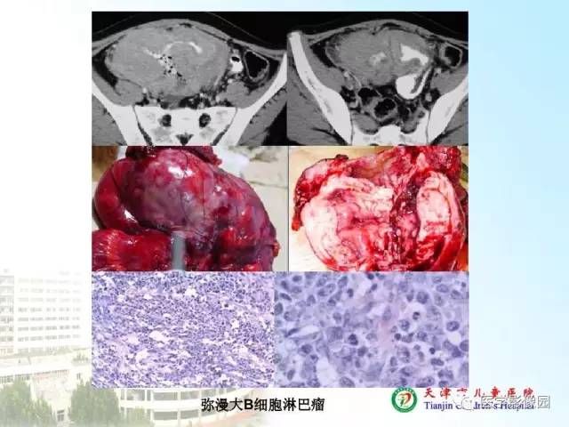 【PPT】小儿腹部肿瘤影像与病理对照