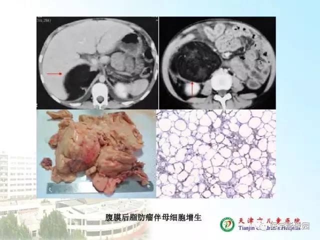 【PPT】小儿腹部肿瘤影像与病理对照