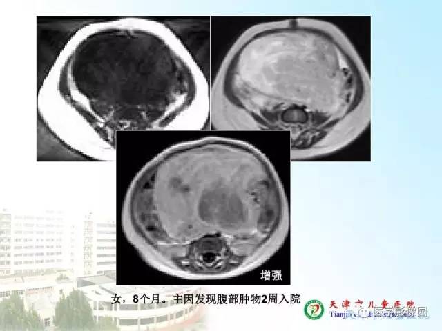 【PPT】小儿腹部肿瘤影像与病理对照