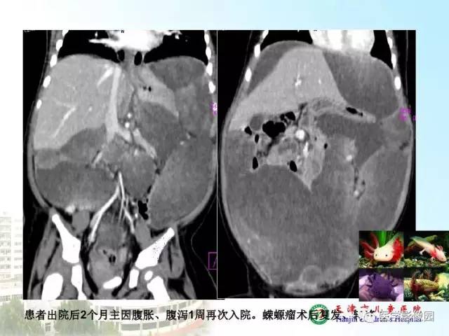 【PPT】小儿腹部肿瘤影像与病理对照