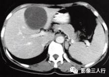 【病例】肝胆管黏液性囊腺瘤1例CT影像表现分析 【病例】肝胆管黏液性囊腺瘤1例CT影像表现分析