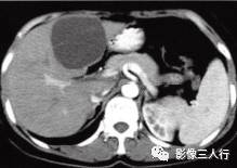 【病例】肝胆管黏液性囊腺瘤1例CT影像表现分析 【病例】肝胆管黏液性囊腺瘤1例CT影像表现分析