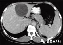 【病例】肝胆管黏液性囊腺瘤1例CT影像表现分析 【病例】肝胆管黏液性囊腺瘤1例CT影像表现分析