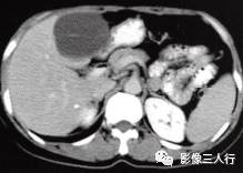 【病例】肝胆管黏液性囊腺瘤1例CT影像表现分析 【病例】肝胆管黏液性囊腺瘤1例CT影像表现分析