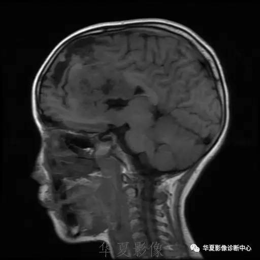 【病例】节细胞胶质瘤1例MR影像表现
