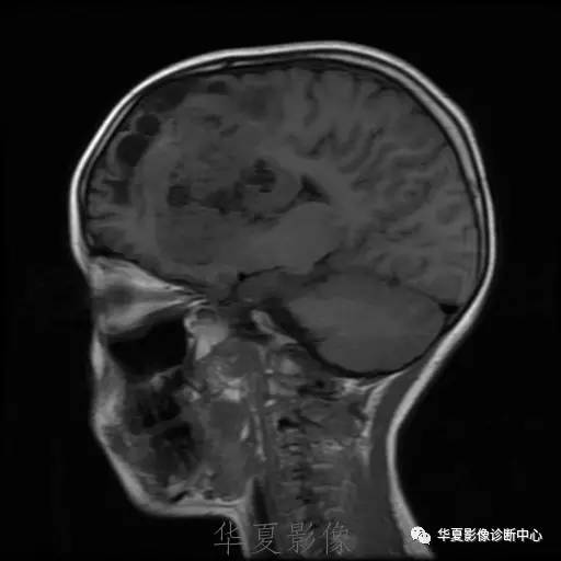 【病例】节细胞胶质瘤1例MR影像表现