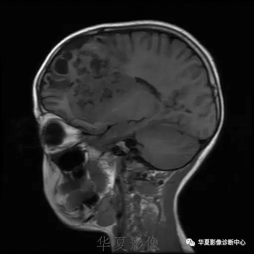 【病例】节细胞胶质瘤1例MR影像表现