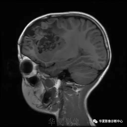 【病例】节细胞胶质瘤1例MR影像表现