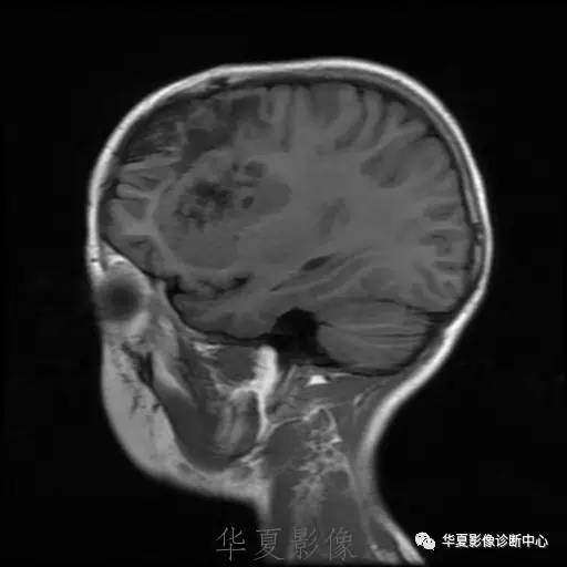 【病例】节细胞胶质瘤1例MR影像表现