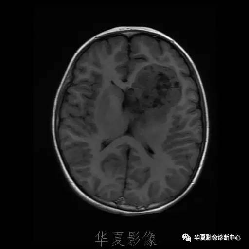 【病例】节细胞胶质瘤1例MR影像表现