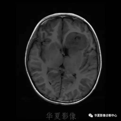 【病例】节细胞胶质瘤1例MR影像表现