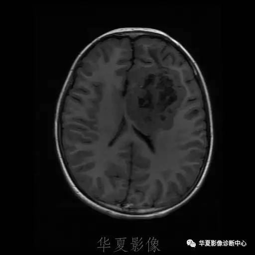 【病例】节细胞胶质瘤1例MR影像表现