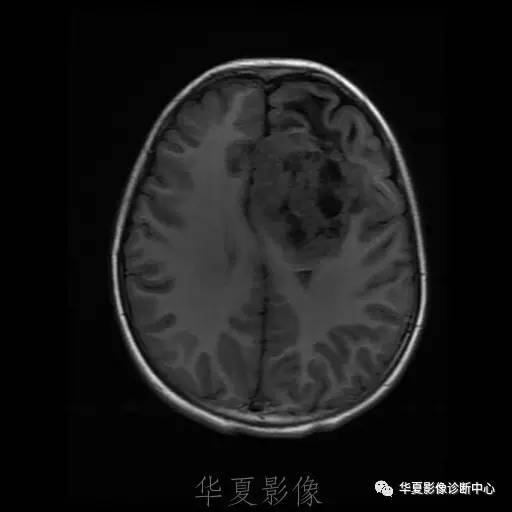 【病例】节细胞胶质瘤1例MR影像表现