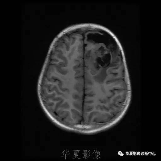 【病例】节细胞胶质瘤1例MR影像表现
