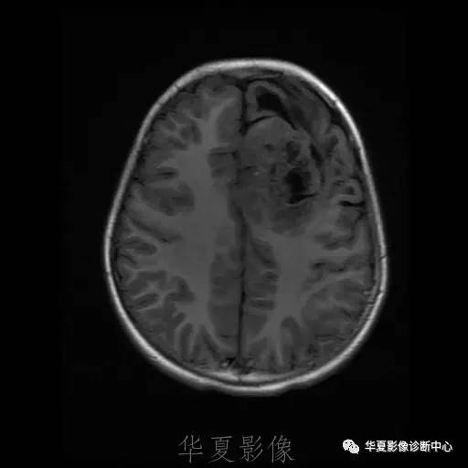 【病例】节细胞胶质瘤1例MR影像表现