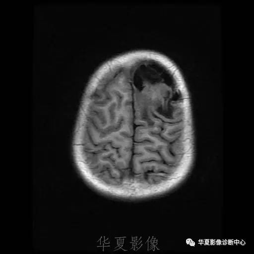 【病例】节细胞胶质瘤1例MR影像表现