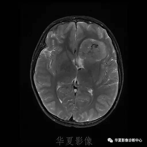 【病例】节细胞胶质瘤1例MR影像表现