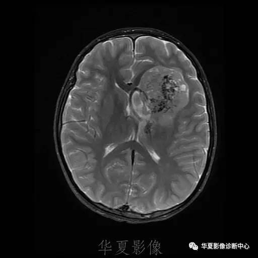 【病例】节细胞胶质瘤1例MR影像表现
