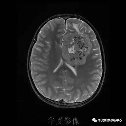 【病例】节细胞胶质瘤1例MR影像表现