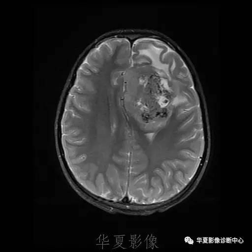 【病例】节细胞胶质瘤1例MR影像表现