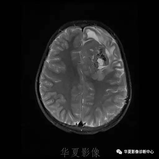 【病例】节细胞胶质瘤1例MR影像表现
