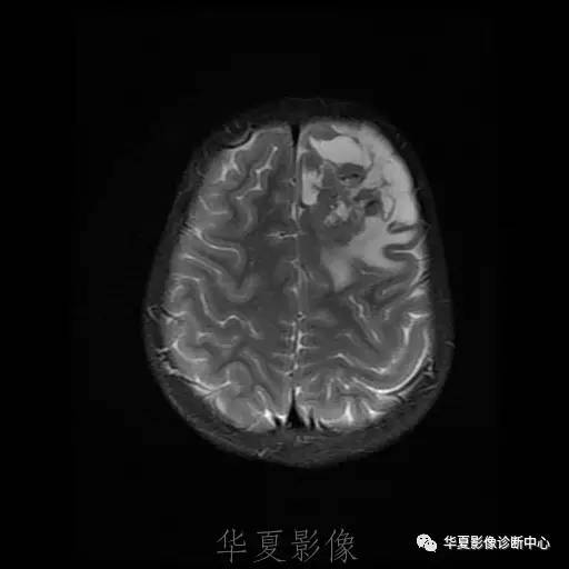 【病例】节细胞胶质瘤1例MR影像表现