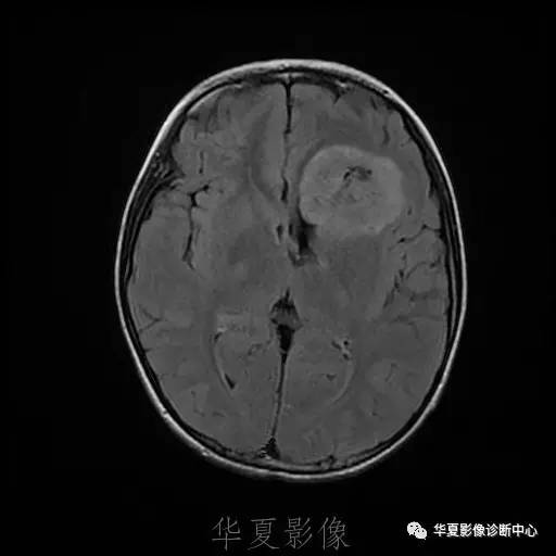 【病例】节细胞胶质瘤1例MR影像表现