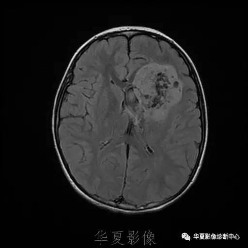 【病例】节细胞胶质瘤1例MR影像表现