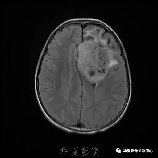 【病例】节细胞胶质瘤1例MR影像表现