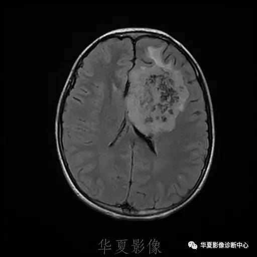 【病例】节细胞胶质瘤1例MR影像表现