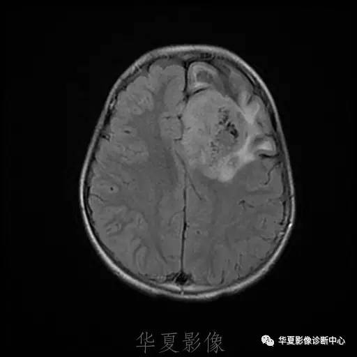 【病例】节细胞胶质瘤1例MR影像表现