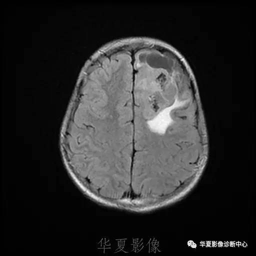 【病例】节细胞胶质瘤1例MR影像表现