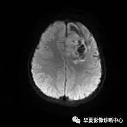 【病例】节细胞胶质瘤1例MR影像表现