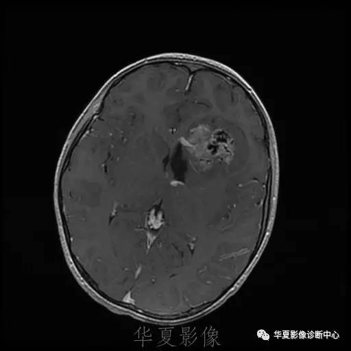 【病例】节细胞胶质瘤1例MR影像表现