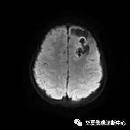 【病例】节细胞胶质瘤1例MR影像表现