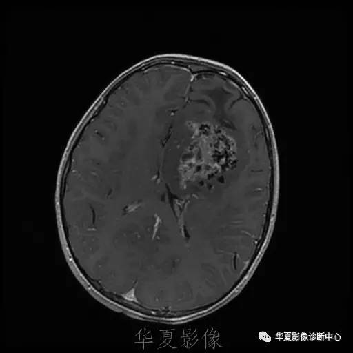 【病例】节细胞胶质瘤1例MR影像表现