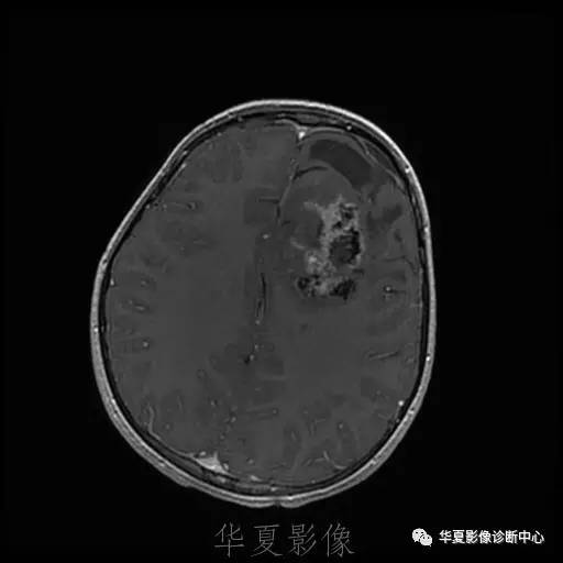 【病例】节细胞胶质瘤1例MR影像表现