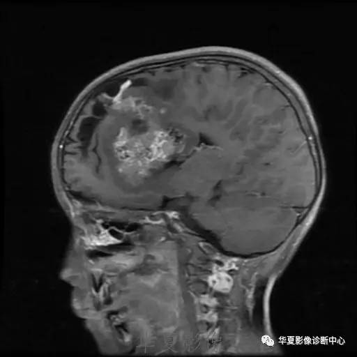 【病例】节细胞胶质瘤1例MR影像表现
