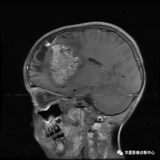 【病例】节细胞胶质瘤1例MR影像表现
