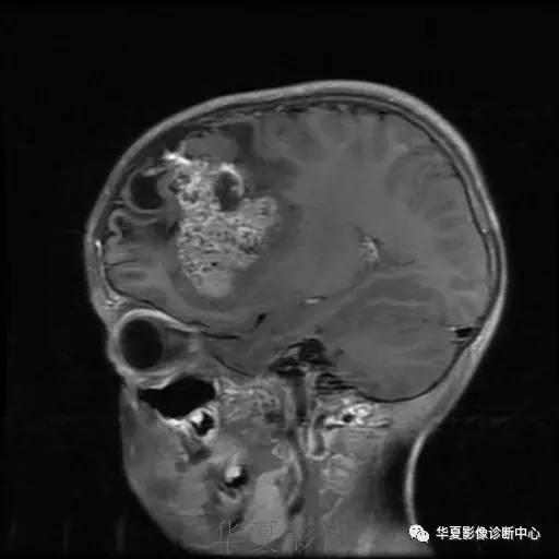 【病例】节细胞胶质瘤1例MR影像表现