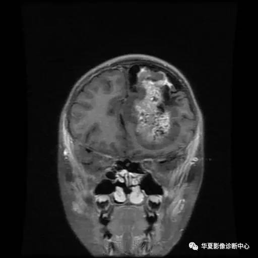 【病例】节细胞胶质瘤1例MR影像表现