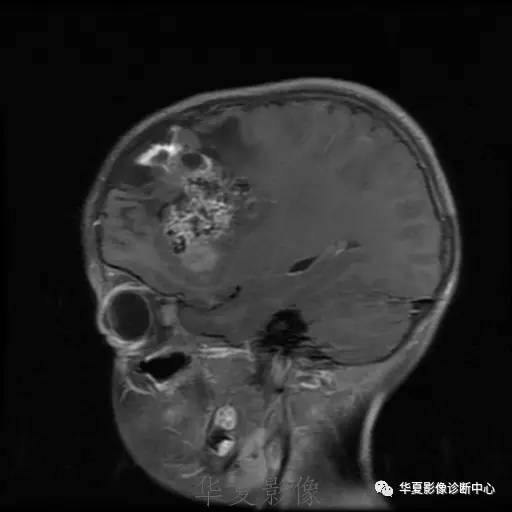 【病例】节细胞胶质瘤1例MR影像表现