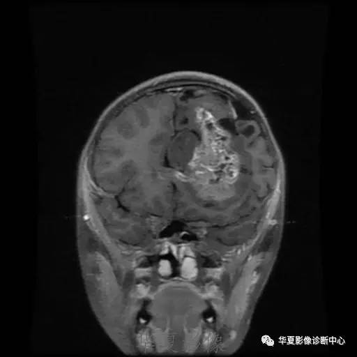 【病例】节细胞胶质瘤1例MR影像表现