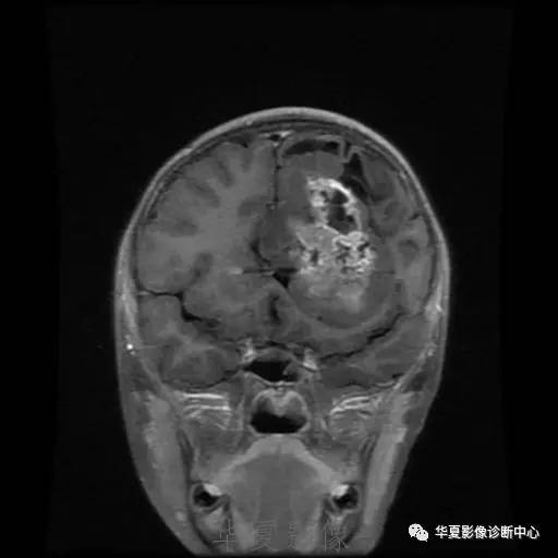 【病例】节细胞胶质瘤1例MR影像表现