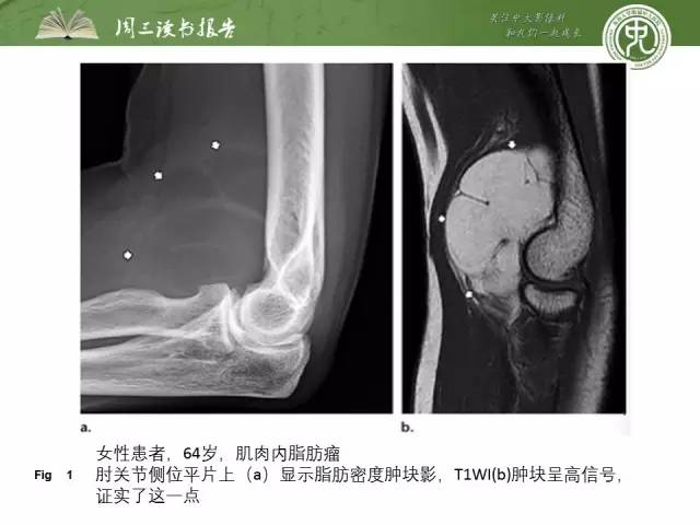 【PPT】骨骼肌肉系统肿块影像学成像基本概念