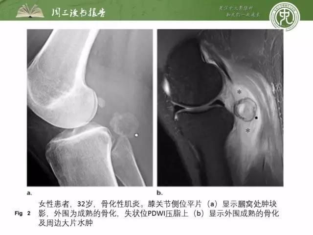 【PPT】骨骼肌肉系统肿块影像学成像基本概念