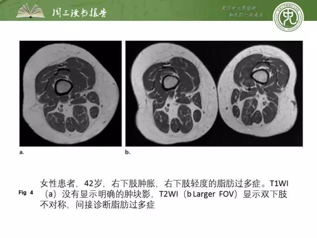 【PPT】骨骼肌肉系统肿块影像学成像基本概念
