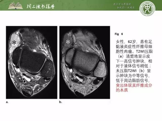 【PPT】骨骼肌肉系统肿块影像学成像基本概念